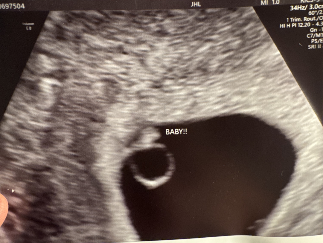 卵巢早衰AMH仅0.3，美国EFC一促一移成功上岸