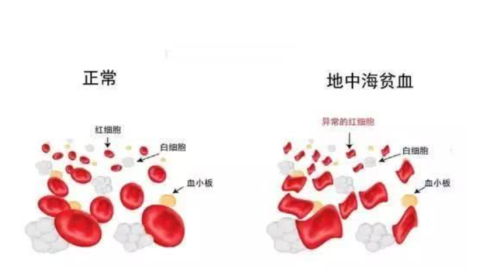 泰国EKI-IVF地中海贫血与试管婴儿