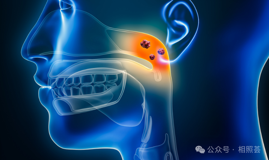 鼻咽癌&ldquo;去化疗方案&rdquo;：PD-1+诱导化疗，3年无进展生存率达88%！
