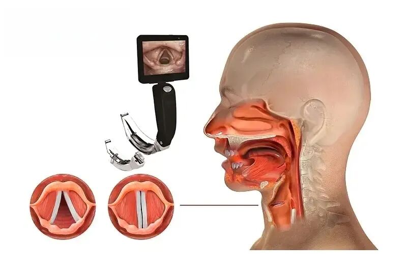 可视喉申请怎么【麻醉科】全身麻醉手术“隐形守护者”：可视喉镜气管插管，你了解吗？_https://www.jmylbn.com_新闻资讯_第4张