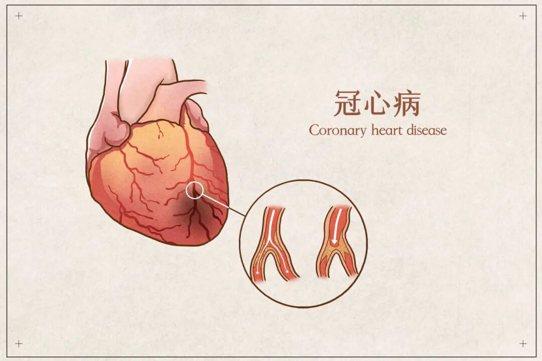 摄图网_401789046_冠心病医疗插画示意图(非企业商用).jpg