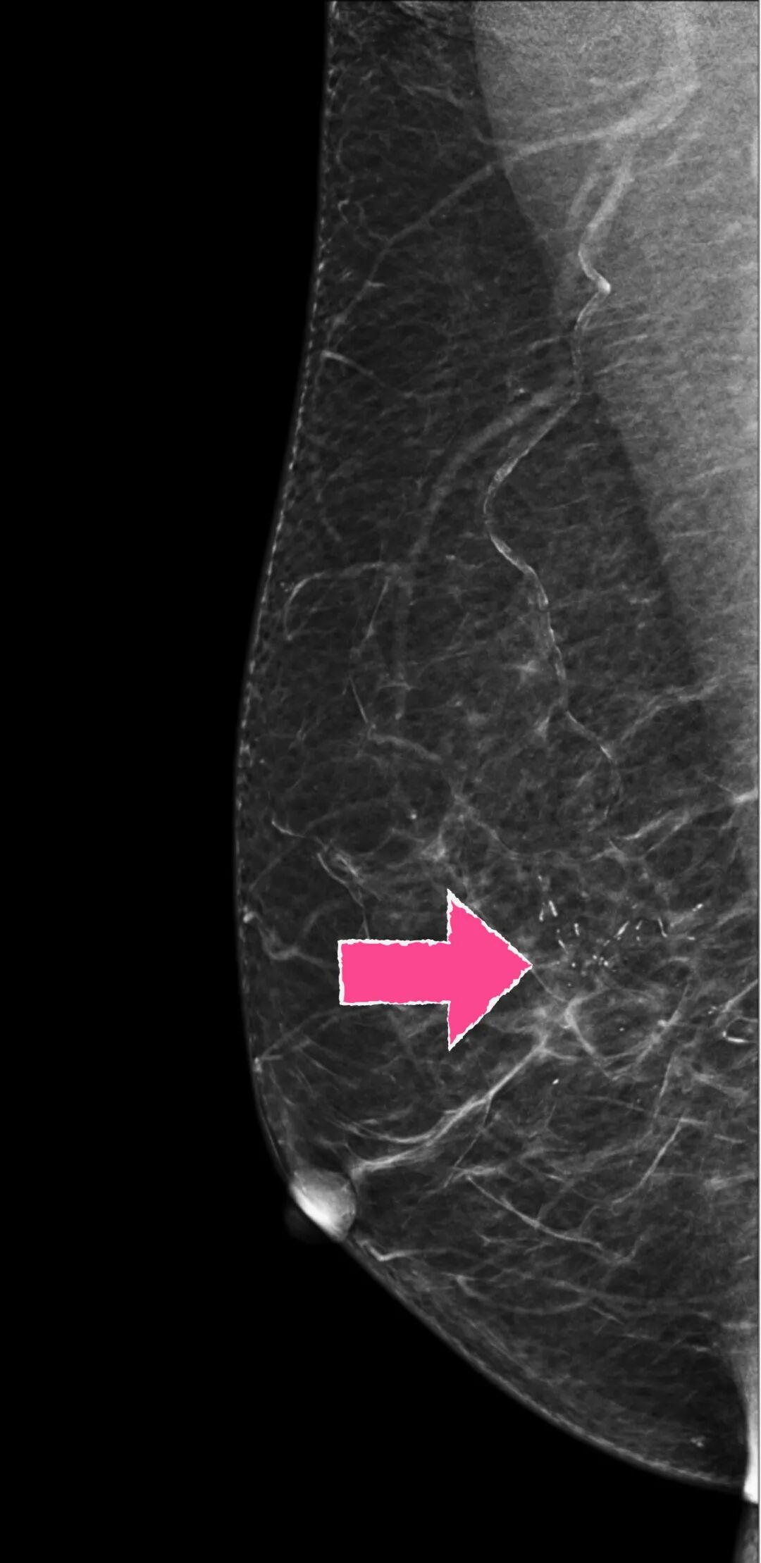 怎么制造手术钩针狙击乳腺结节癌变！这种新技术专揪早期乳腺癌_https://www.jmylbn.com_新闻资讯_第5张