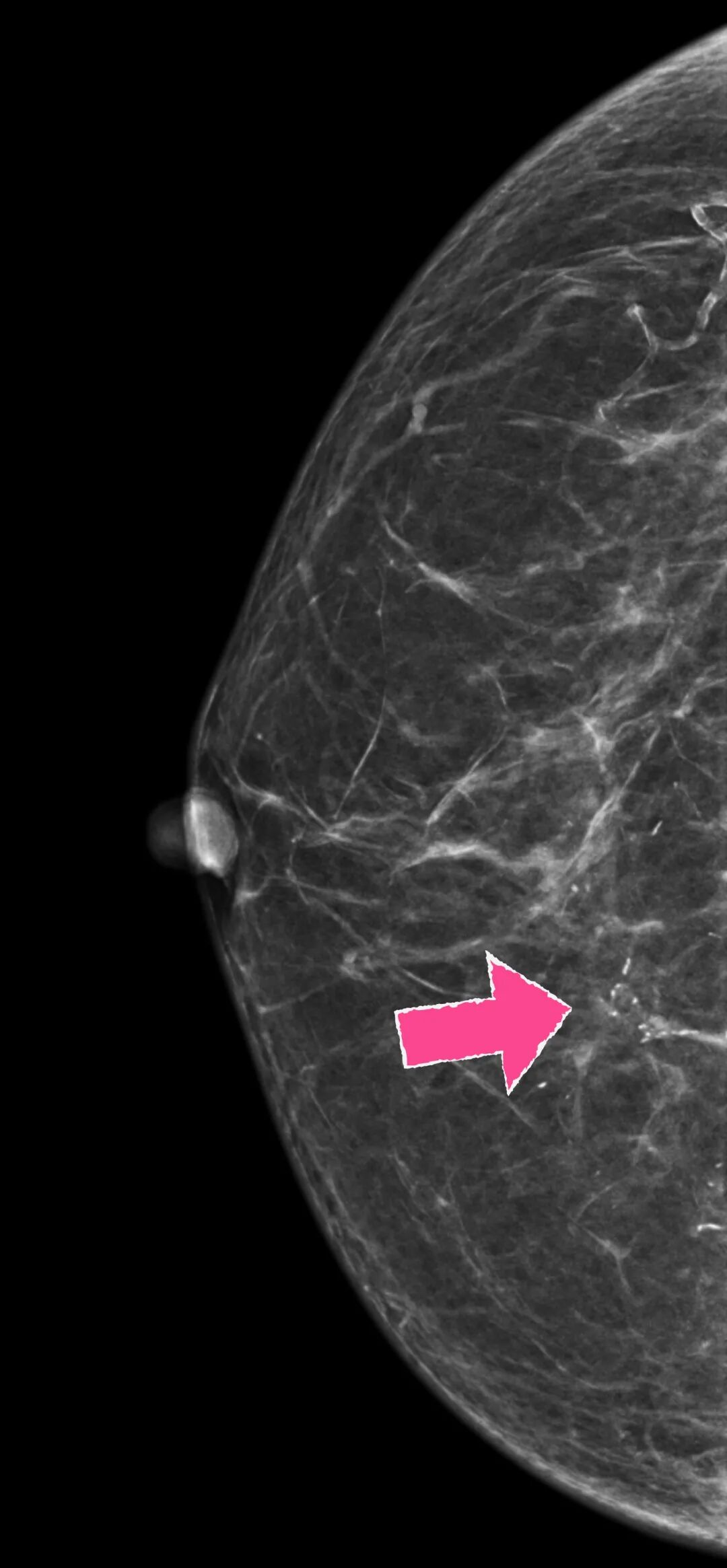 怎么制造手术钩针狙击乳腺结节癌变！这种新技术专揪早期乳腺癌_https://www.jmylbn.com_新闻资讯_第4张