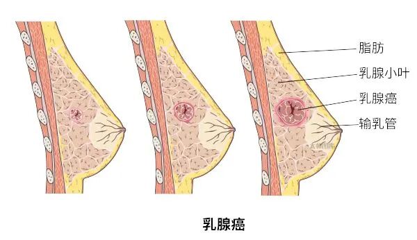 怎么制造手术钩针狙击乳腺结节癌变！这种新技术专揪早期乳腺癌_https://www.jmylbn.com_新闻资讯_第12张
