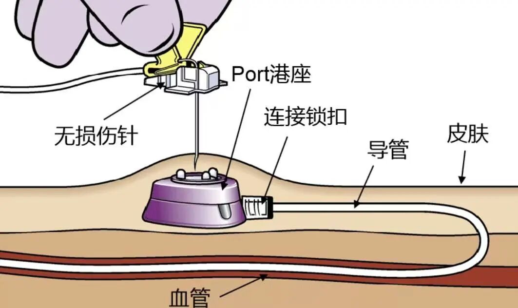 什么是port手术告别反复穿刺！“输液港” 让治疗更舒适-上海聚慕医疗器械有限公司