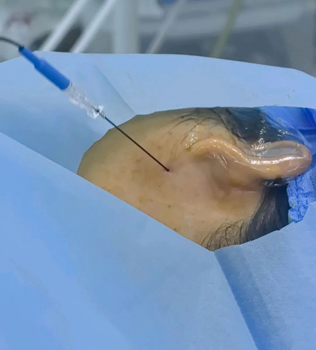 疼痛科怎么理疗面瘫针灸理疗都没用？疼痛科医生15分钟射频治疗，让瘫痪的脸“活”过来！_https://www.jmylbn.com_新闻资讯_第3张