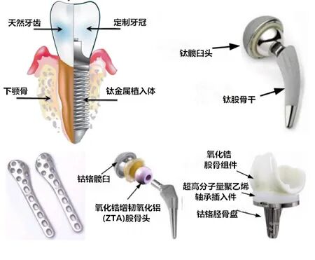 钽涂层在植入医疗器械中的应用