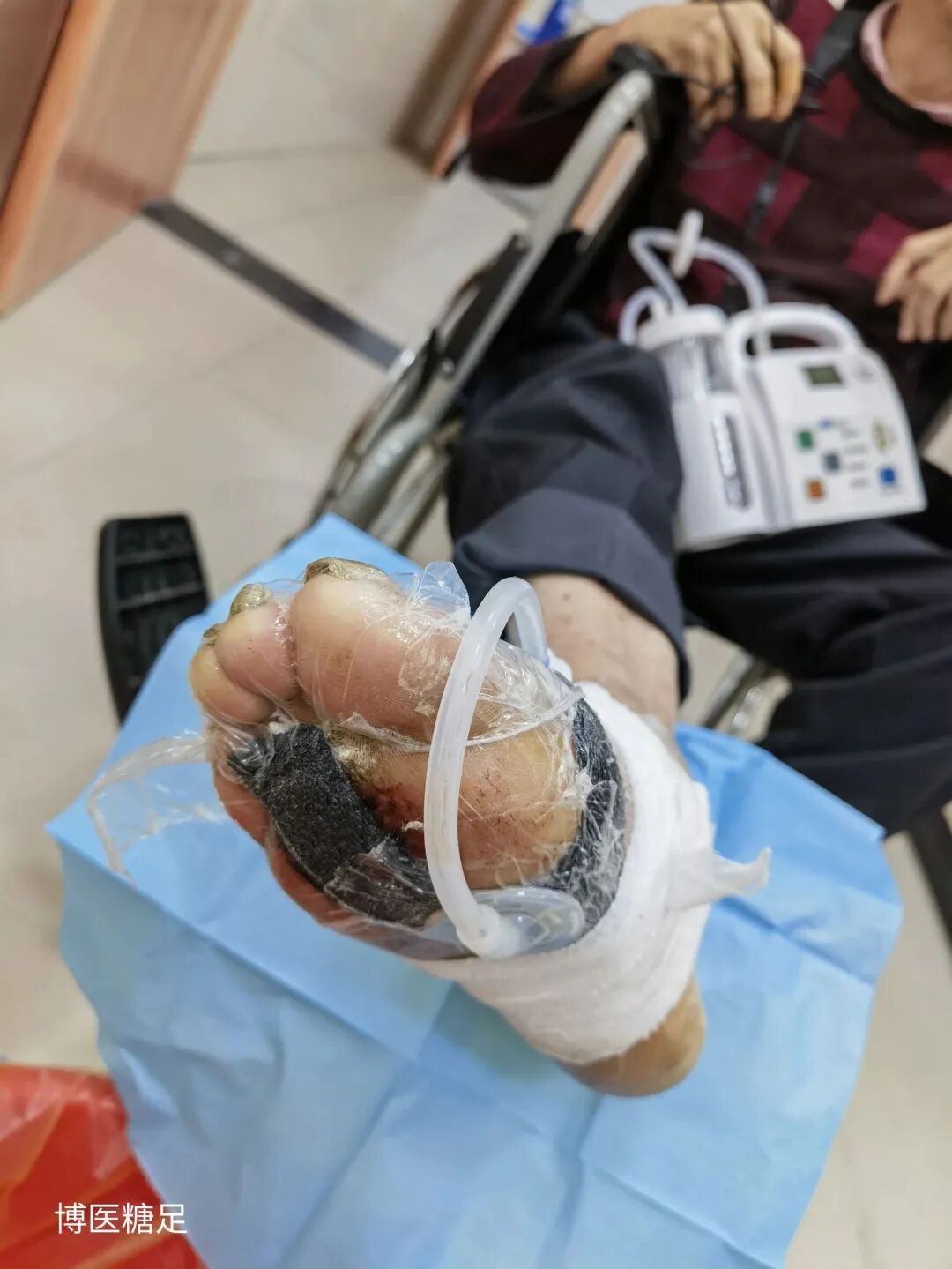 什么是vsd负压引流糖尿病足危害大，VSD技术助力康复_https://www.jmylbn.com_新闻资讯_第9张