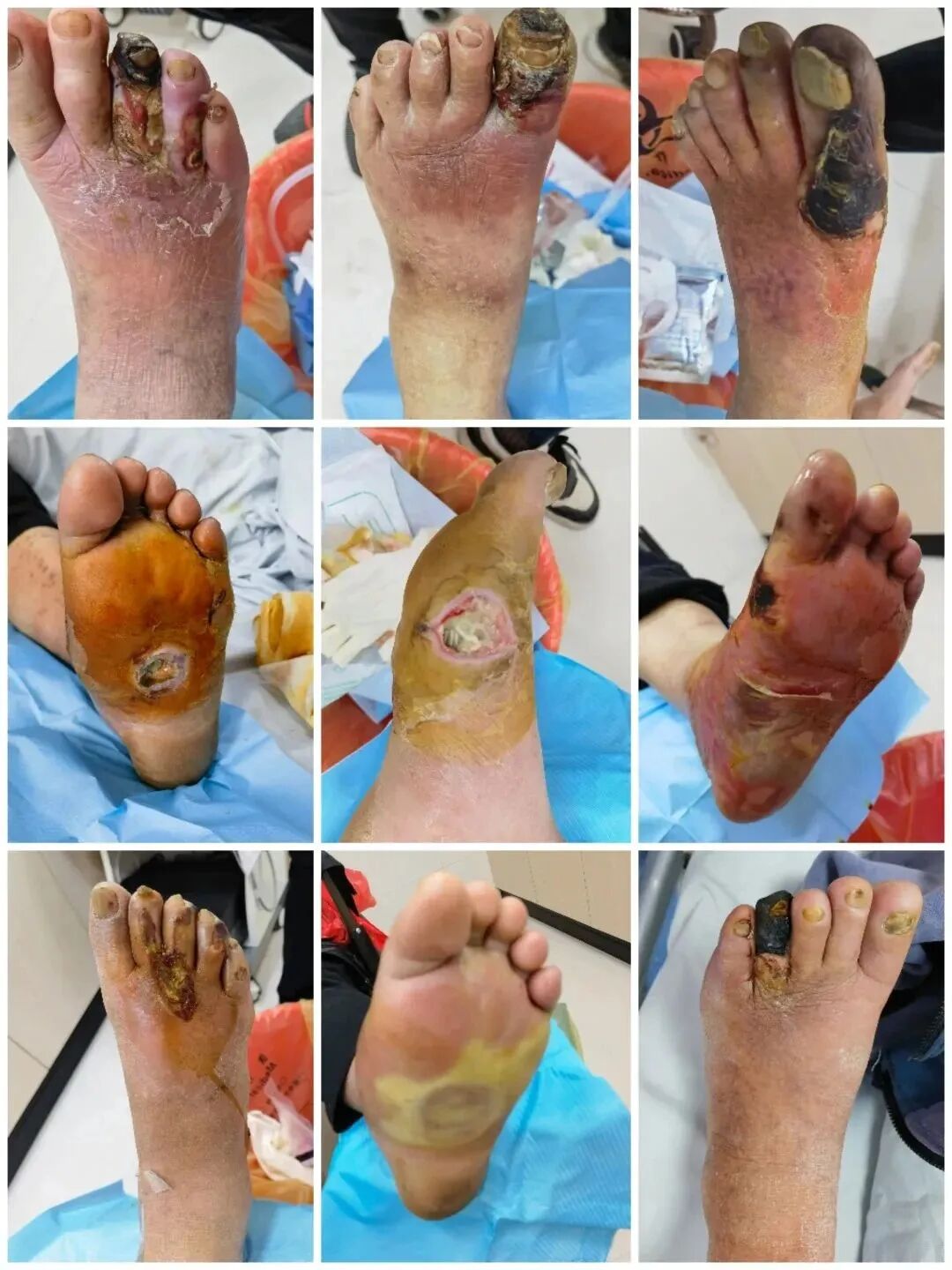 什么是vsd负压引流糖尿病足危害大，VSD技术助力康复_https://www.jmylbn.com_新闻资讯_第5张