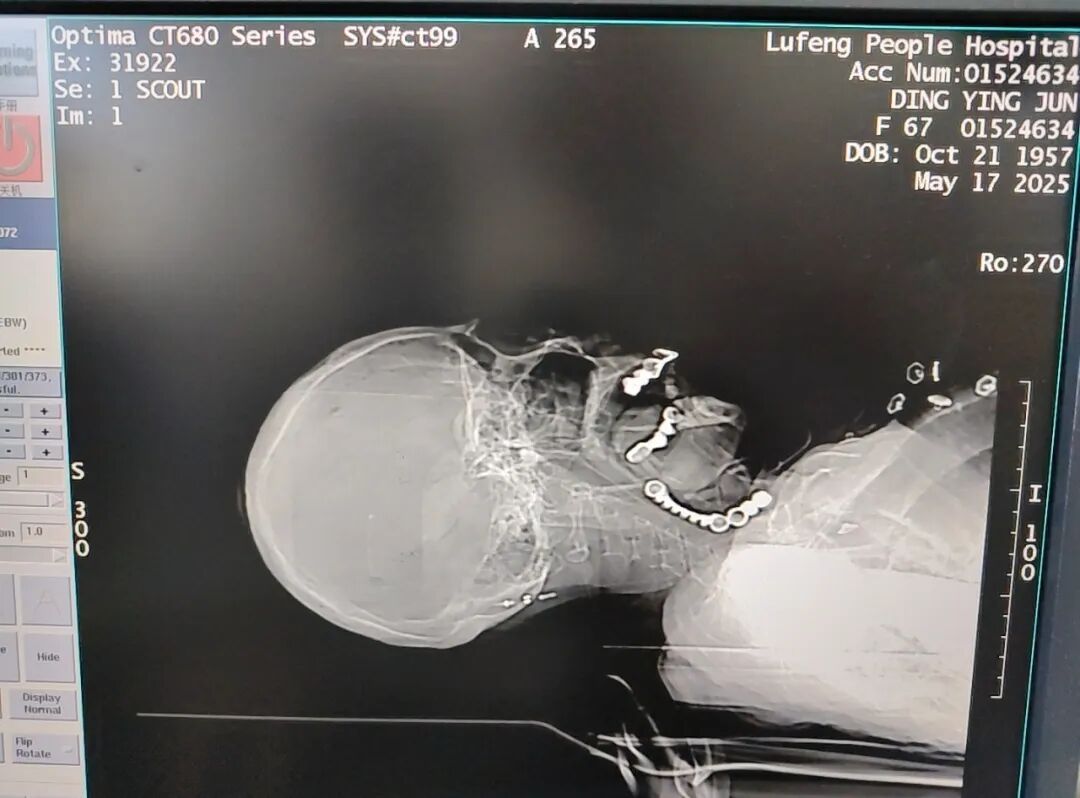 为什么购买可视硬性喉镜【急诊日志】脑梗老人呼吸困难，急诊CT揪出元凶，可视喉镜技术助脱险_https://www.jmylbn.com_新闻资讯_第3张