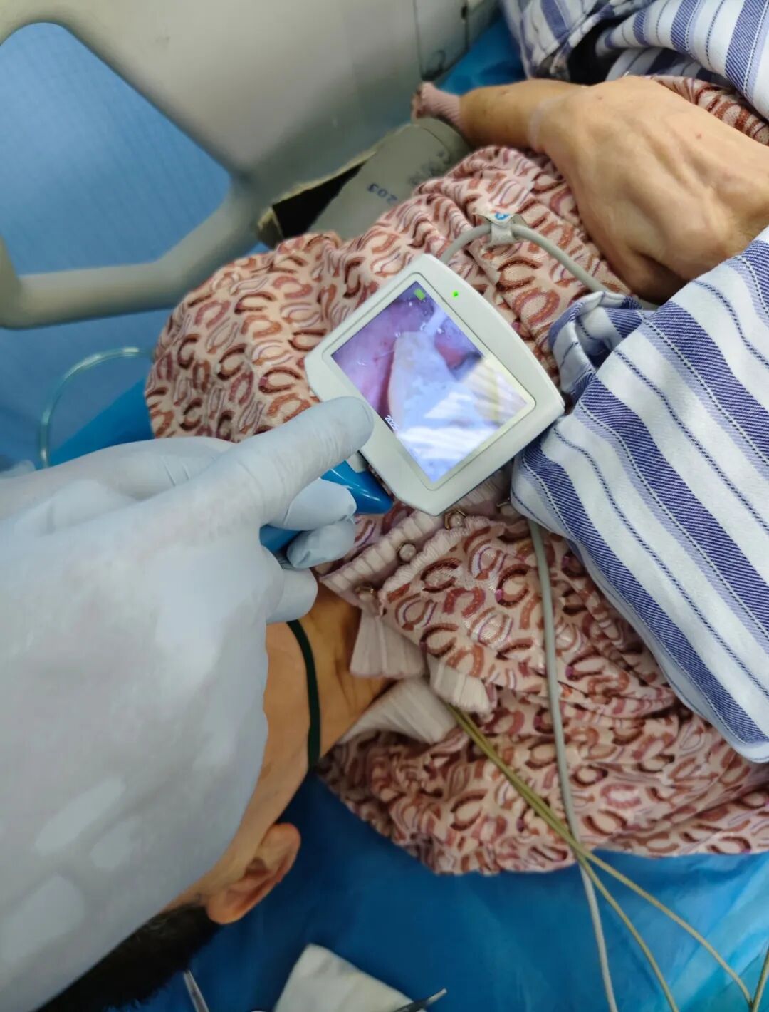 为什么购买可视硬性喉镜【急诊日志】脑梗老人呼吸困难，急诊CT揪出元凶，可视喉镜技术助脱险_https://www.jmylbn.com_新闻资讯_第4张