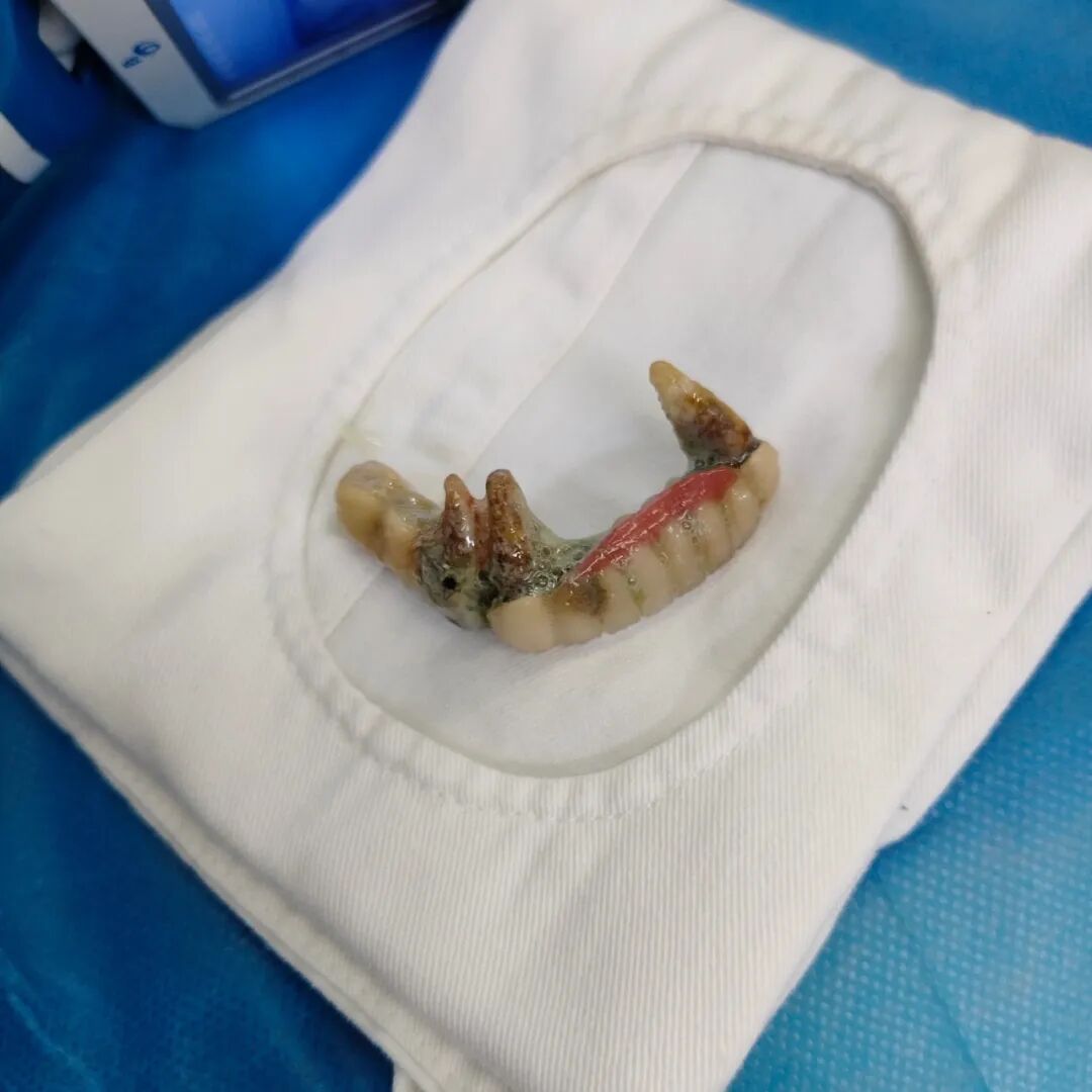 为什么购买可视硬性喉镜【急诊日志】脑梗老人呼吸困难，急诊CT揪出元凶，可视喉镜技术助脱险_https://www.jmylbn.com_新闻资讯_第6张