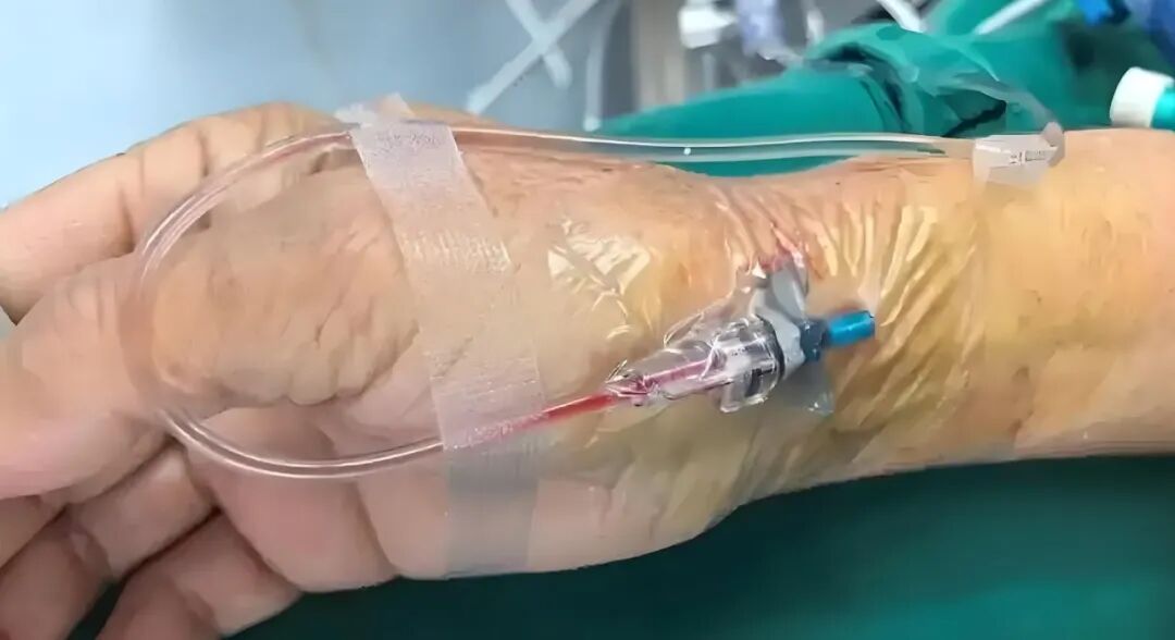 icu里有哪些医用仪器揭秘ICU：那些守护生命的“秘密武器”_https://www.jmylbn.com_新闻资讯_第8张