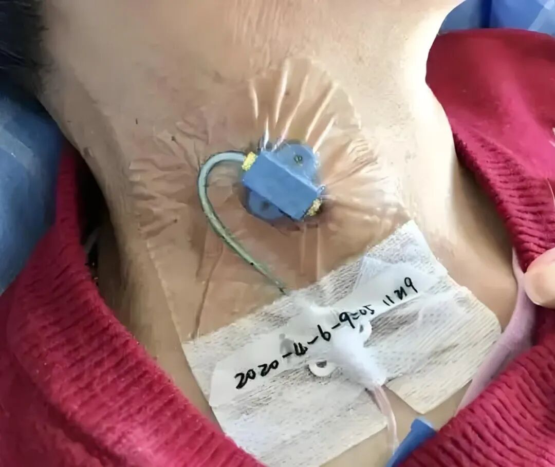 icu里有哪些医用仪器揭秘ICU：那些守护生命的“秘密武器”_https://www.jmylbn.com_新闻资讯_第7张