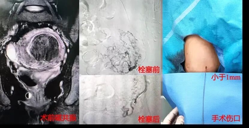 为什么要用到微导管济医附院成功开展“无鞘微导管技术”治疗子宫肌瘤_https://www.jmylbn.com_新闻资讯_第3张