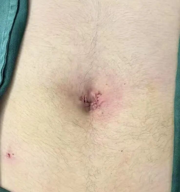 怎么制造手术钩针告别“疤”恼！微创美学新选择——钩针辅助下腹腔镜单位置切口阑尾切除术（HLA）_https://www.jmylbn.com_新闻资讯_第3张