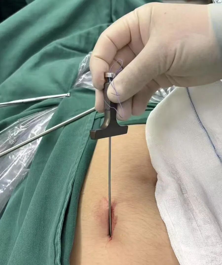 怎么制造手术钩针告别“疤”恼！微创美学新选择——钩针辅助下腹腔镜单位置切口阑尾切除术（HLA）_https://www.jmylbn.com_新闻资讯_第2张