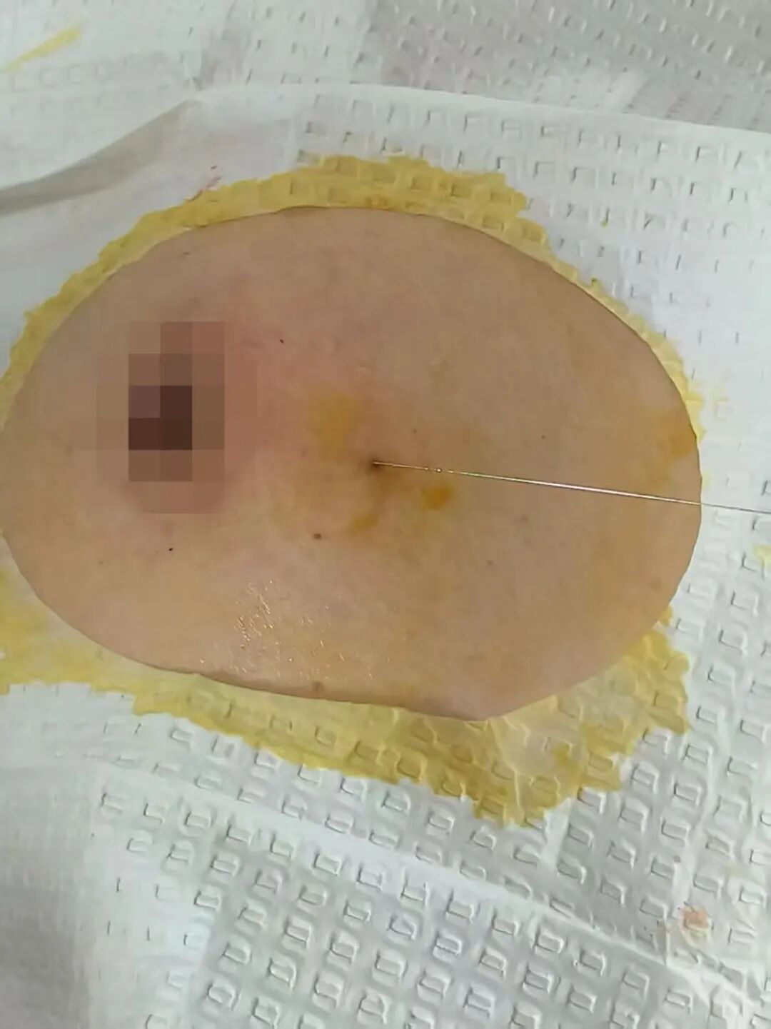 为什么要定位针 乳腺【苏州市中医医院丨聚焦专科】小钩针，大作用，让乳腺小结节无处可逃_https://www.jmylbn.com_新闻资讯_第6张