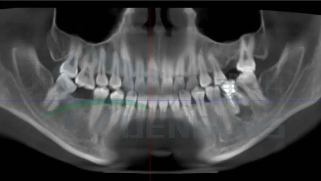死髓牙拔除案例_画板 1.jpg
