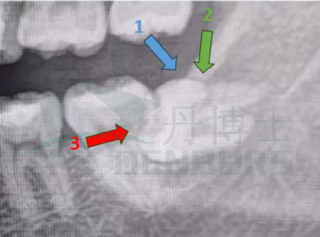阻生齿案例-03.jpg