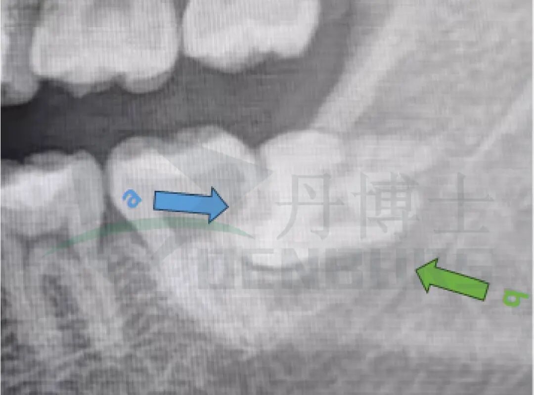 阻生齿案例-04.jpg