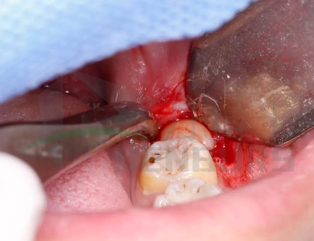 阻生齿案例-08.jpg
