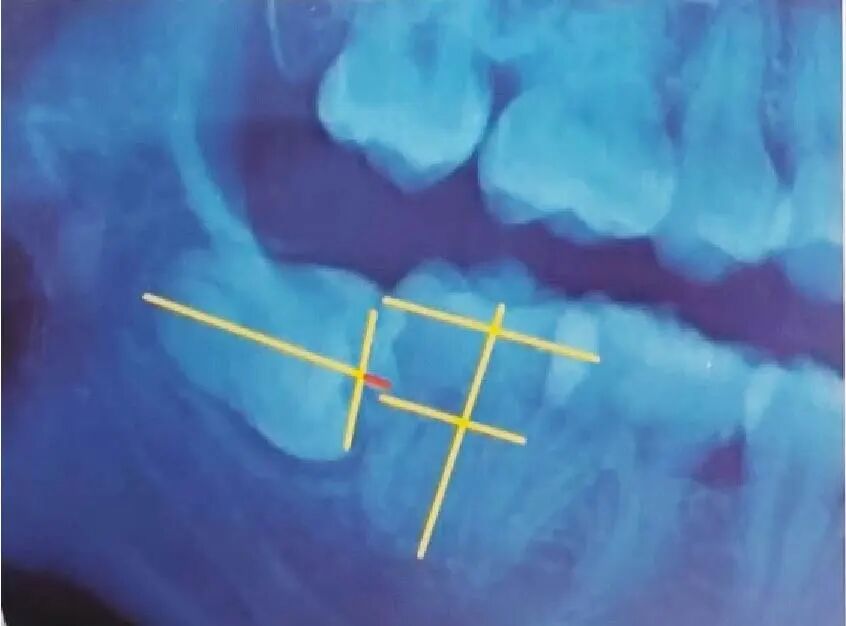 阻生齿-04.jpg
