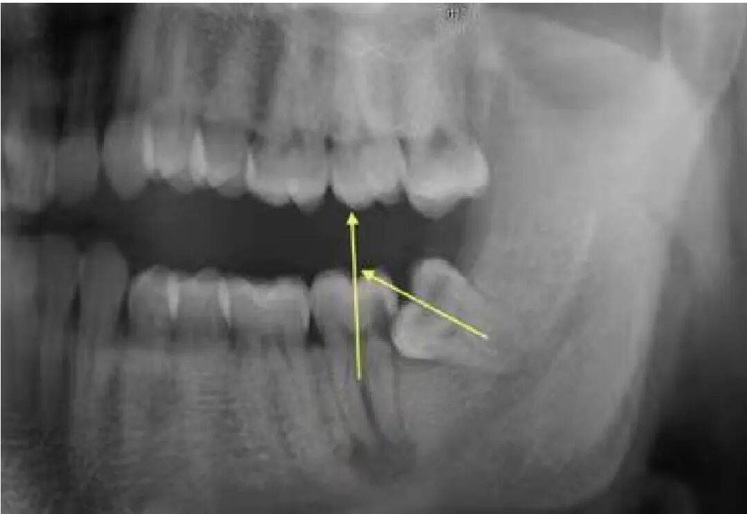 阻生齿-12.jpg