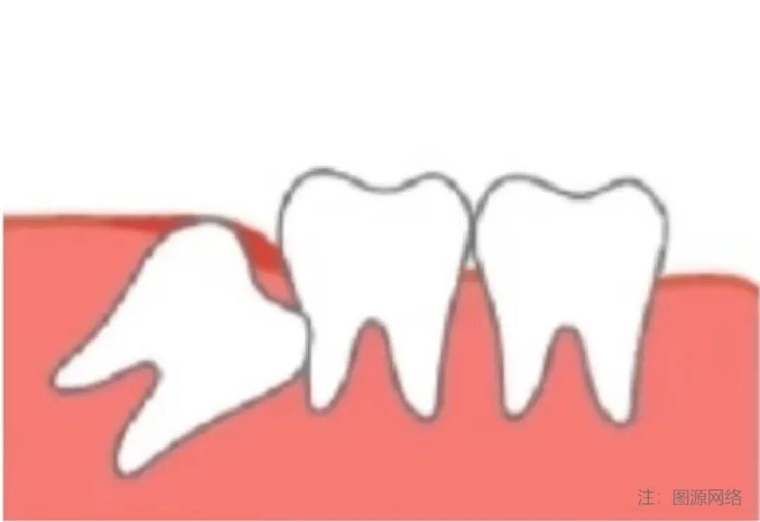 阻生齿-06.jpg