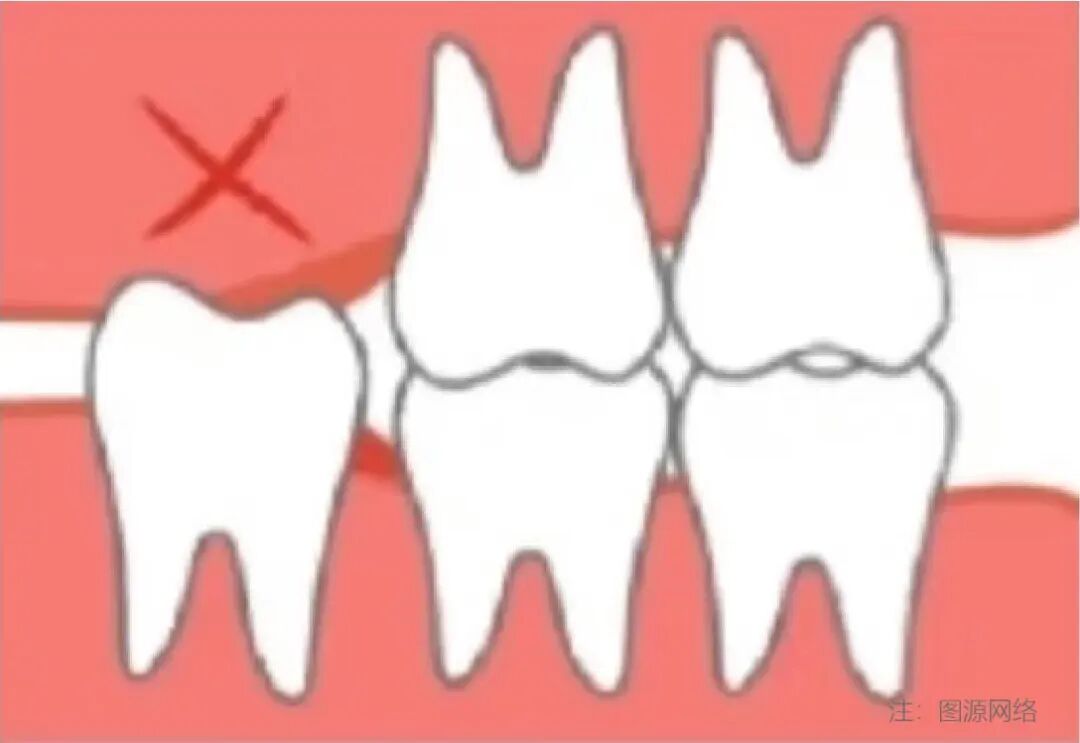 阻生齿-11.jpg