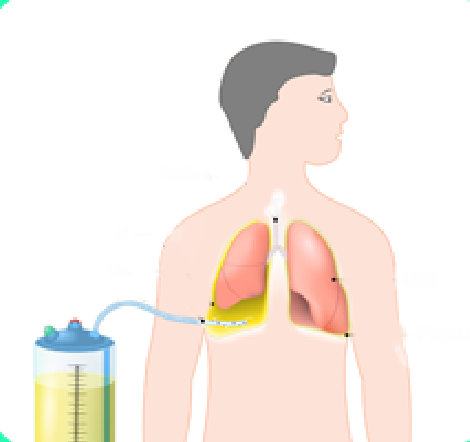引流袋管子怎么不流术后身上这根管子，如何远离感染风险？_https://www.jmylbn.com_新闻资讯_第2张