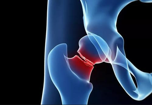 骨密度影是什么【科普】骨质疏松症影像、骨密度检查及表现_https://www.jmylbn.com_新闻资讯_第7张