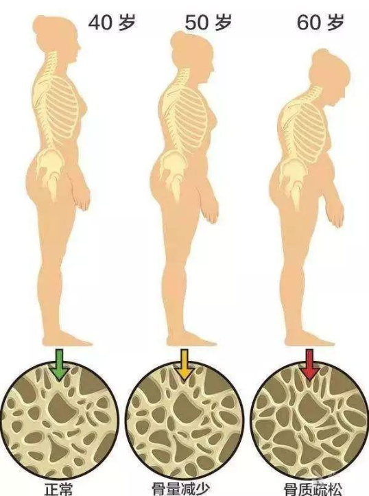 骨密度影是什么【科普】骨质疏松症影像、骨密度检查及表现_https://www.jmylbn.com_新闻资讯_第6张
