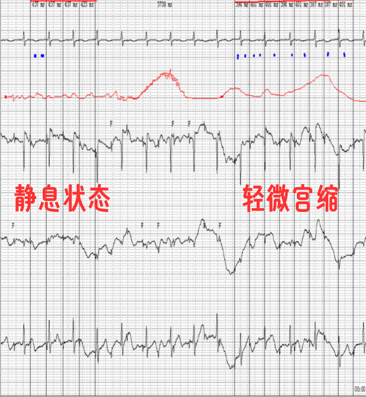 胎儿心电图是什么意思胎儿也能做心电图吗？_https://www.jmylbn.com_新闻资讯_第4张