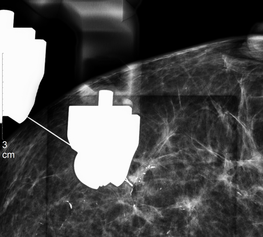 怎么制造手术钩针狙击乳腺结节癌变！这种新技术专揪早期乳腺癌_https://www.jmylbn.com_新闻资讯_第7张