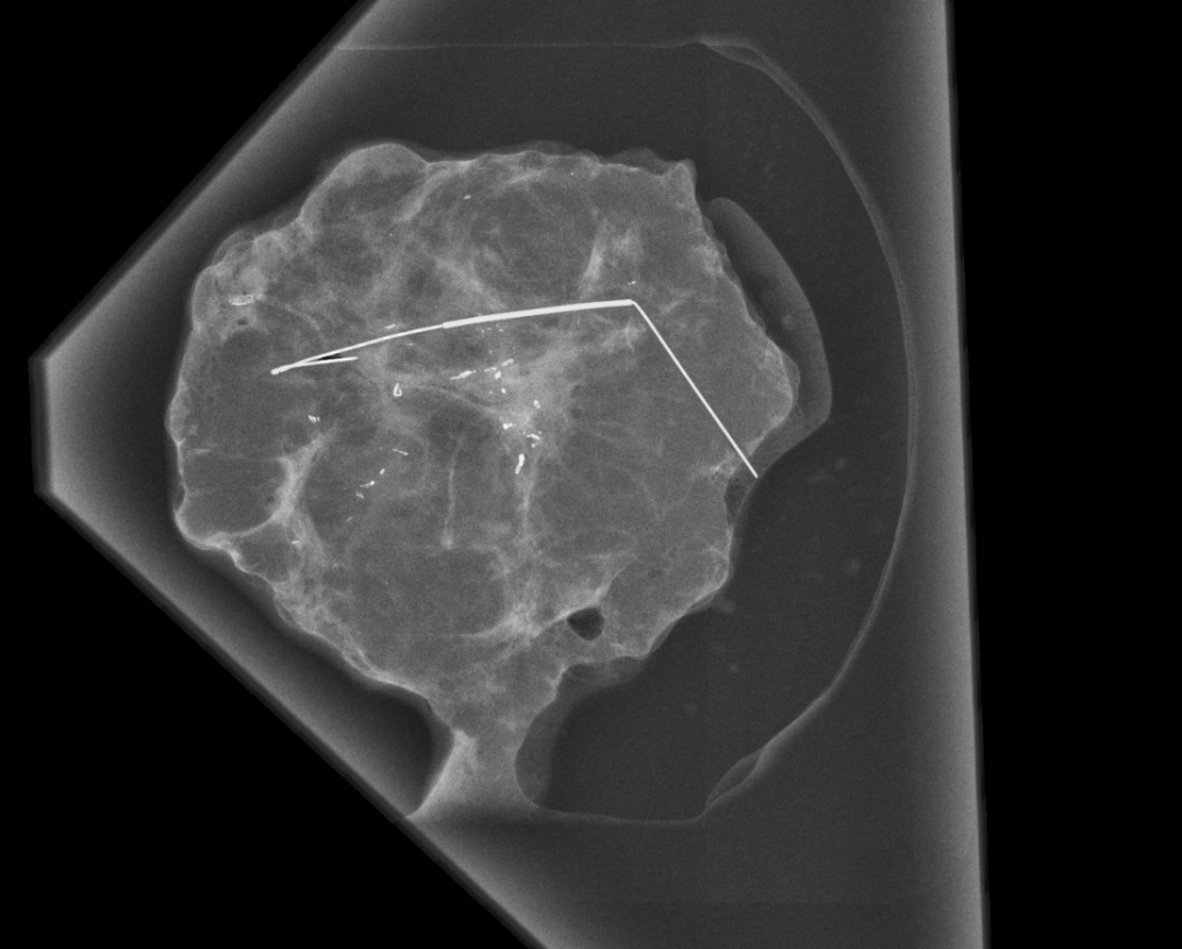怎么制造手术钩针狙击乳腺结节癌变！这种新技术专揪早期乳腺癌_https://www.jmylbn.com_新闻资讯_第8张