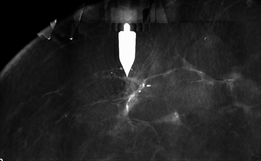 怎么制造手术钩针狙击乳腺结节癌变！这种新技术专揪早期乳腺癌_https://www.jmylbn.com_新闻资讯_第6张