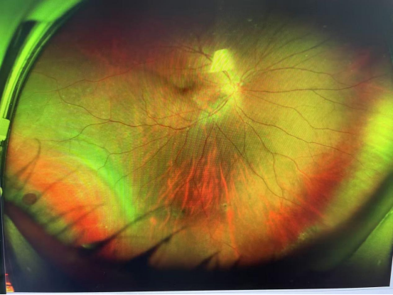 眼底激光机有什么牌子好奇：眼底生病了，为什么要打激光？_https://www.jmylbn.com_新闻资讯_第3张