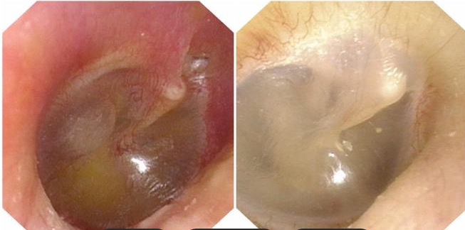 中耳筛查怎么做孩子听力筛查没通过？解密耳朵里的“积液密码”_https://www.jmylbn.com_新闻资讯_第17张