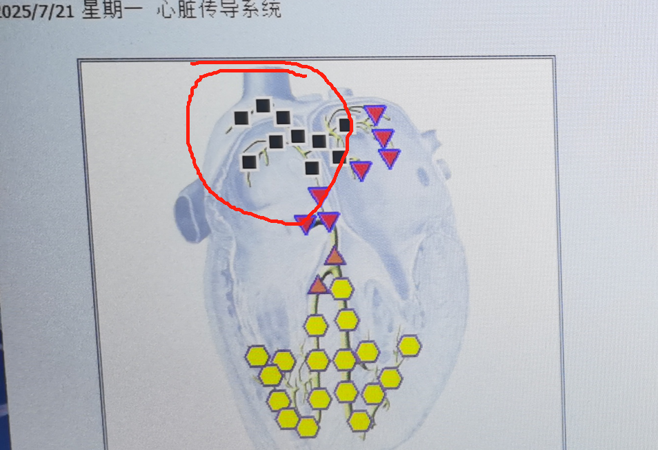 你身边有心梗离世的案例吗,心梗：潜伏的“狙击手”正对中年人实施“围猎”
