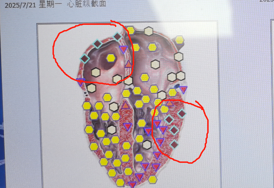 你身边有心梗离世的案例吗
