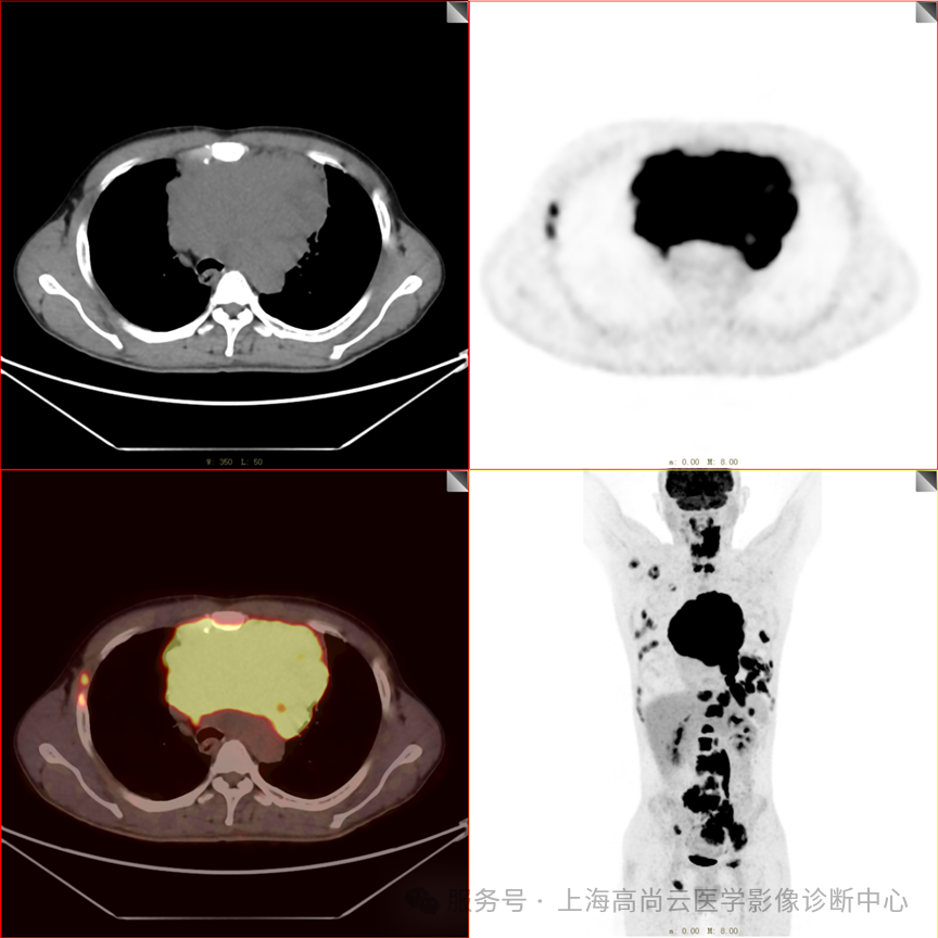 【高尚病例】纵隔 T 细胞淋巴瘤