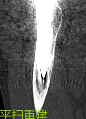 放射科怎么打印放射科新技术助力3D打印精准置换——记一例人工髋关节置换术后假体脱位患者的个性化治疗_https://www.jmylbn.com_新闻资讯_第6张