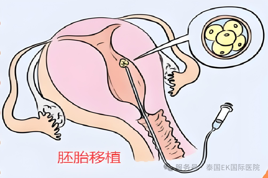 泰国三代试管可移植新鲜胚胎吗？EKI-IVF