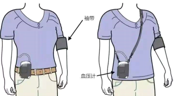 动态血压怎么佩带医疗科普｜佩戴24小时动态血压监测仪需要注意的4大要点_https://www.jmylbn.com_新闻资讯_第6张