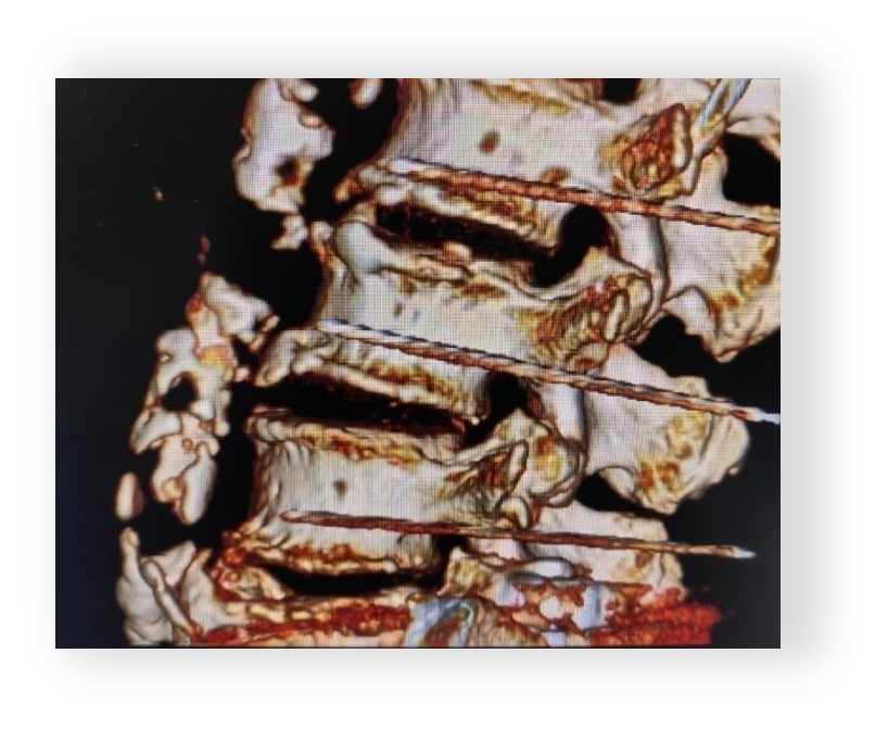射频什么科认识疼痛科 ｜ 北京市健宫医院疼痛科完成第5000例射频技术案例，患者左下肢烧灼样疼痛伴麻木累及大腿，严重影响睡眠及行走_https://www.jmylbn.com_新闻资讯_第15张