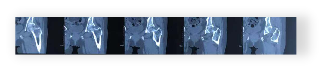 射频什么科认识疼痛科 ｜ 北京市健宫医院疼痛科完成第5000例射频技术案例，患者左下肢烧灼样疼痛伴麻木累及大腿，严重影响睡眠及行走_https://www.jmylbn.com_新闻资讯_第7张