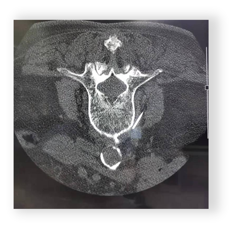 射频什么科认识疼痛科 ｜ 北京市健宫医院疼痛科完成第5000例射频技术案例，患者左下肢烧灼样疼痛伴麻木累及大腿，严重影响睡眠及行走_https://www.jmylbn.com_新闻资讯_第14张