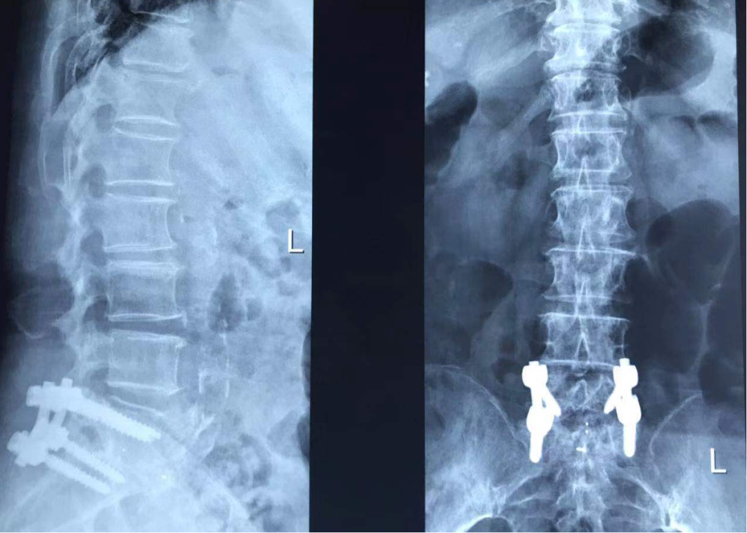 射频什么科认识疼痛科 ｜ 北京市健宫医院疼痛科完成第5000例射频技术案例，患者左下肢烧灼样疼痛伴麻木累及大腿，严重影响睡眠及行走_https://www.jmylbn.com_新闻资讯_第6张