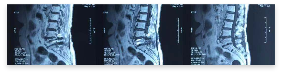 射频什么科认识疼痛科 ｜ 北京市健宫医院疼痛科完成第5000例射频技术案例，患者左下肢烧灼样疼痛伴麻木累及大腿，严重影响睡眠及行走_https://www.jmylbn.com_新闻资讯_第8张
